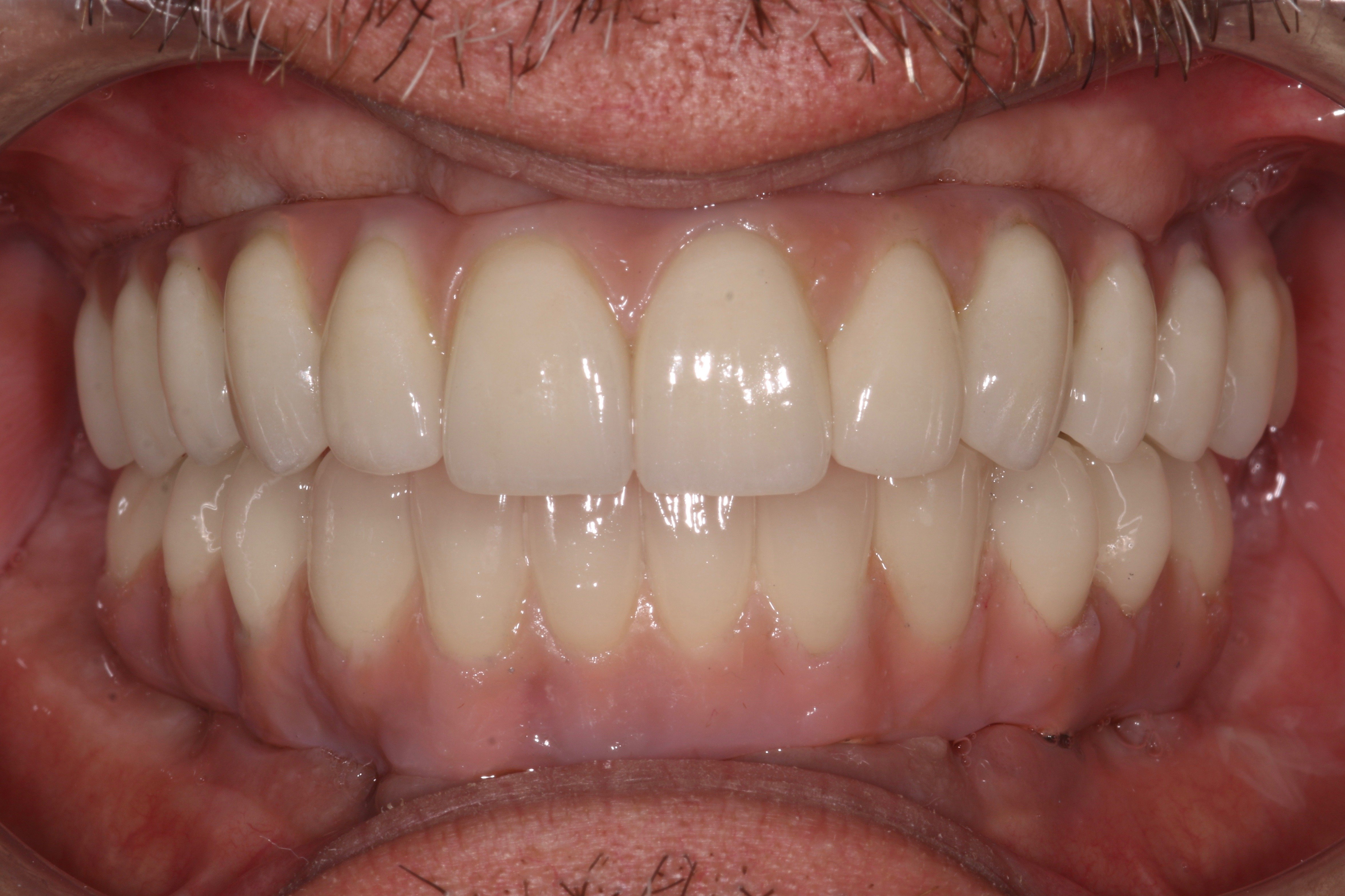 Dental Implants in Nottingham The Campbell Clinic